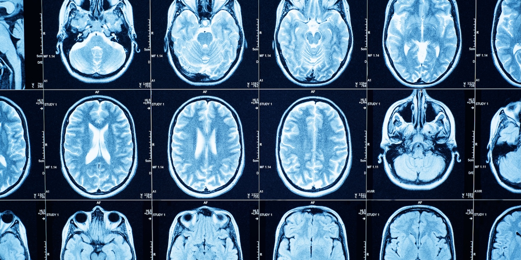 Nahaufnahme eines CT-Scans eines menschlichen Gehirns